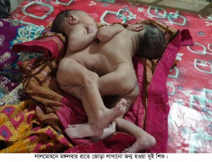 লালমোহনে জোড়া লাগানো দুই যমজ শিশুর জন্ম উন্নত চিকিৎসার জন্য ঢাকায় প্রেরণ