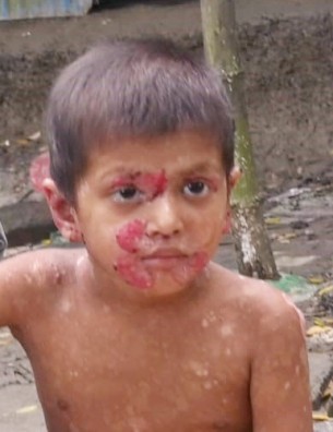 ভোলায় বিরল চর্মরোগে এক শিশু আক্রান্ত