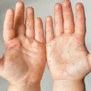 হাম ও উপসর্গে আরও ৪ শিশুর মৃত্যু